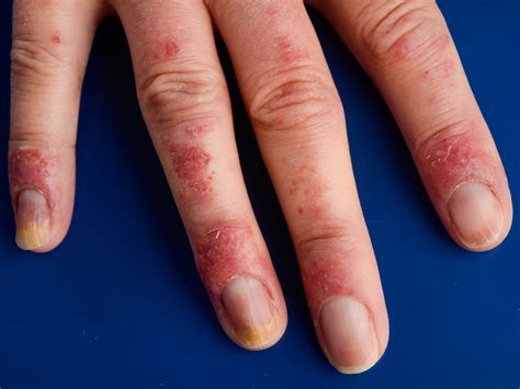 Lupus Rash On Knuckles