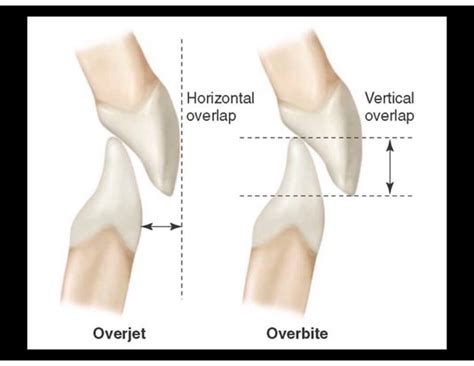 Malocclusion - difference between overbite, overjet and open bite ...