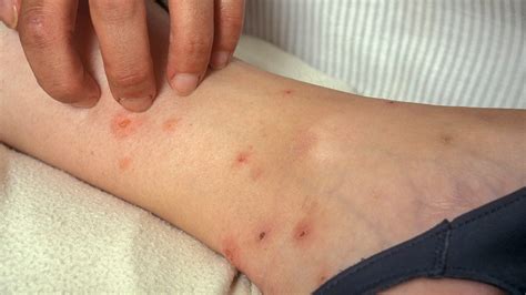 Smart Info About How To Diagnose Bed Bug Bites - Spellquestion