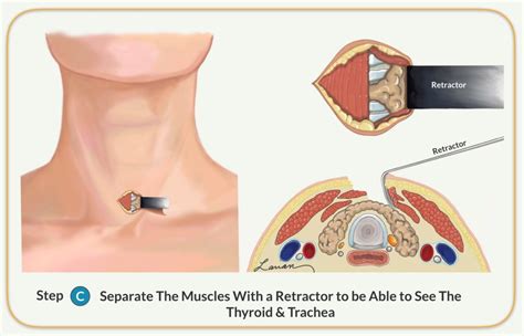 Parathyroidectomy - Parathyroid Gland Removal Surgery | Dr. Larian