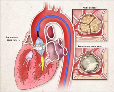 Seguimento pós TAVI: aspectos ecocardiográficos - Blog Ecope