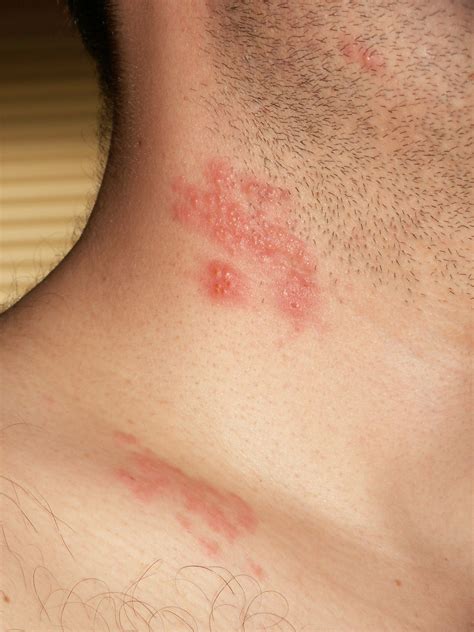 Herpes zoster | Shingles, Varicella-Zoster, Pain Relief | Britannica