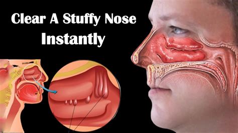 How to Get Rid of a Stuffy Nose Fast || 8 Home Remedies for Stuffy Nose During Pregnancy - YouTube