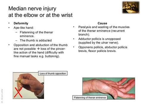 Surgical anatomy of nerve and vascular injuries in the upper limb