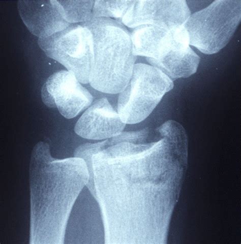 File:Displaced distal radius fracture.jpg - Wikipedia