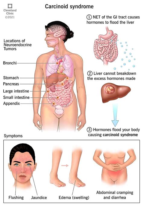 Managing Carcinoid Syndrome: Tips And Strategies - Ask The Nurse Expert