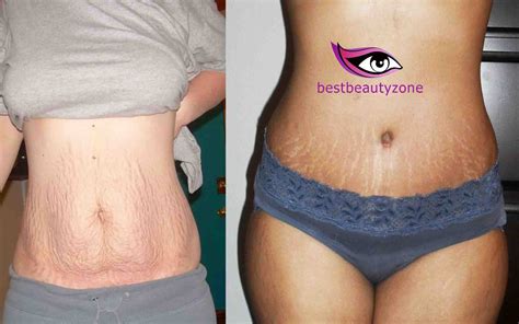 How To Avoid Having Stretch Marks After Weight Loss? - Best Beauty Zone