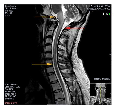 Intracranial Dural Arteriovenous Fistula Presenting With Bulbar and ...