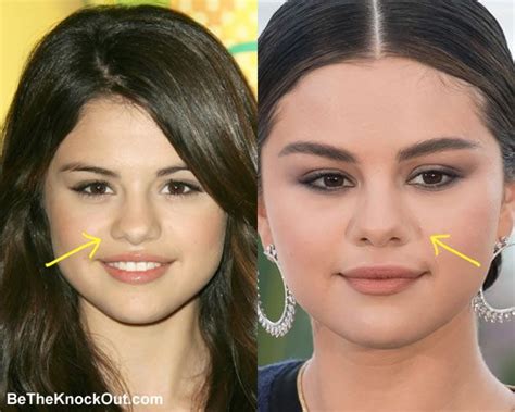 Selena Gomez Plastic Surgery Comparison Photos | Plastic surgery, Selena gomez lips, Selena ...