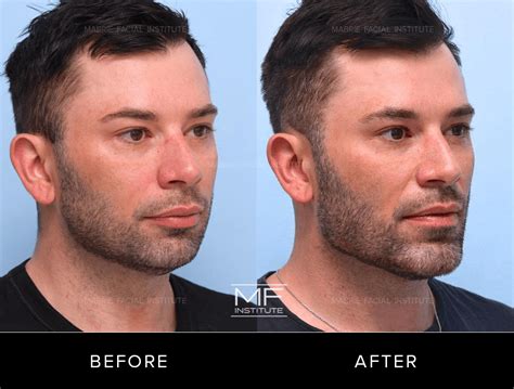 Jawline Filler for Men: Transformative Before and After Photos – Mabrie Facial Institute ...