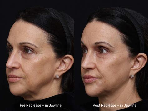 Jawline Contouring and Slimming: Jawline Filler or Jawline Botox ...