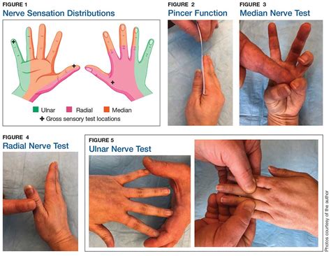 Median Nerve Injury