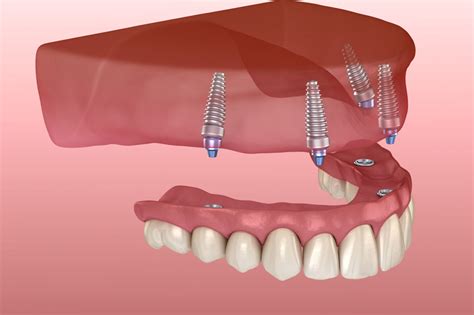 Implant Supported Dentures Maxillary