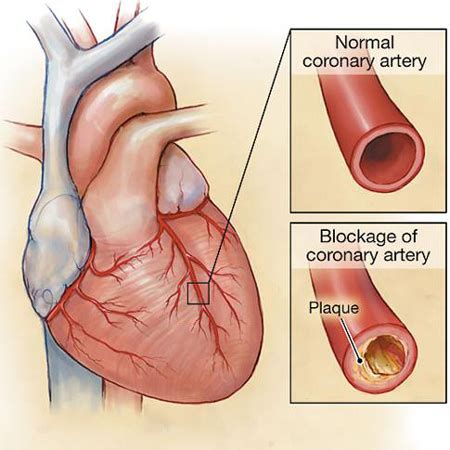 Management of Chronic Stable Angina in 2020 | Cardiology | JN Learning ...