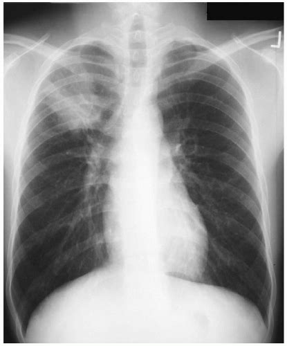 Blastomycosis | Thoracic Key