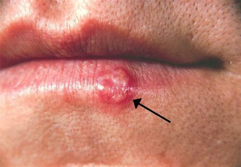 Human Herpesvirus 1 - Infections and Management - dentalnotebook