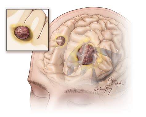 Brain Metastasis | Expert Surgeon | Aaron Cohen-Gadol, MD