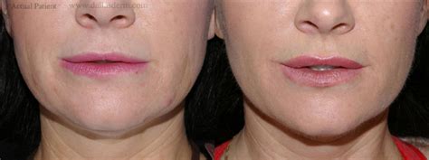 Liquid Face Lift with Restylane/Juvederm/Radiesse | Sculptra | Botox or Dysport