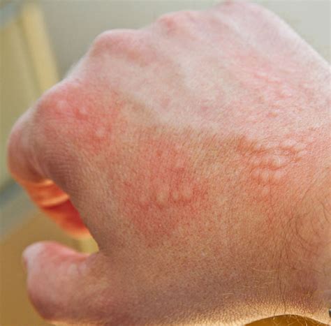 What Is A Skin Rash And How To Treat It Marietta Foot - vrogue.co