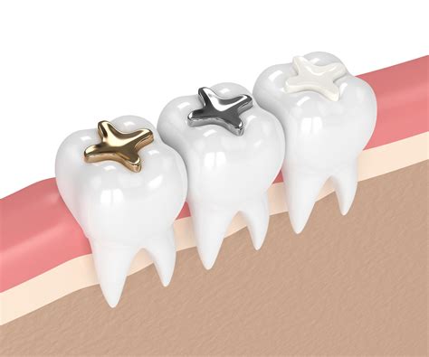 Porcelain Fillings vs. Silver Fillings | Sarasota Dentistry