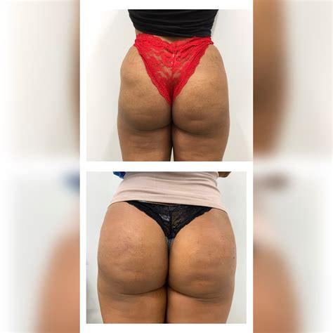 Sculptra Butt Lift - Non Surgical BBL Toronto - Skinatomy