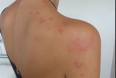 Bed Bug Rash | Symptoms & Appearence, 5+ Treatment Methods (With Photos)