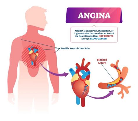 Causas y soluciones para la angina de pecho - Pregúntale a Frank