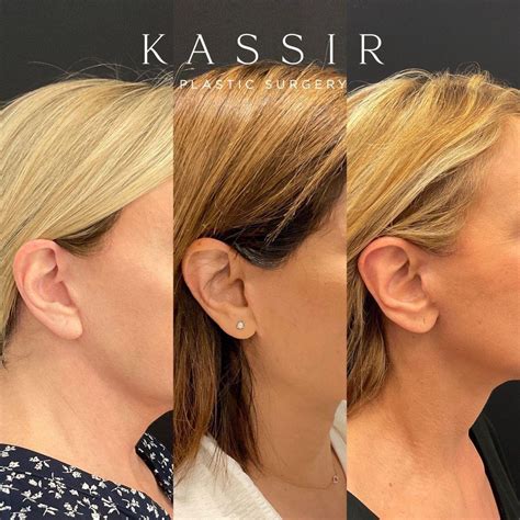 How to treat Facelift Scars — Kassir Plastic Surgery in NY and NJ