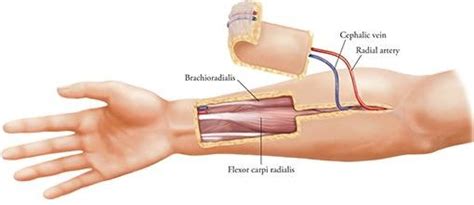 Radial forearm free flap (Morita et al., 2018) | Download Scientific Diagram