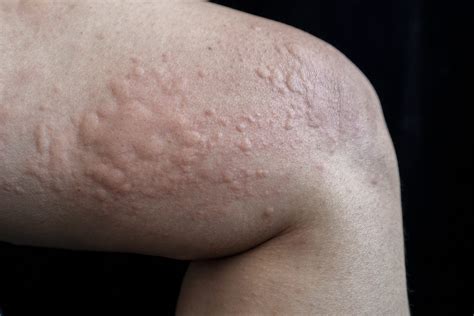 Chronic Spontaneous Urticaria or Chronic Hives | Oregon Medical Research Center