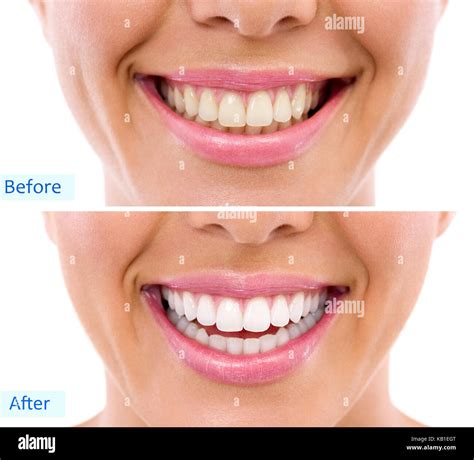 whitening - bleaching treatment ,before and after ,woman teeth and Stock Photo: 161687928 - Alamy