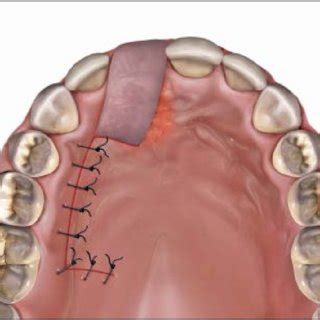 The donor site for the pedicle graft began approximately at the distal... | Download Scientific ...