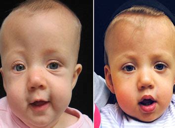 Craniosynostosis Surgery Cost in India | Hospitals | Surgeons