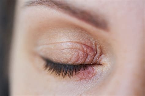 Eyelid Psoriasis: Symptoms, Treatment, and More