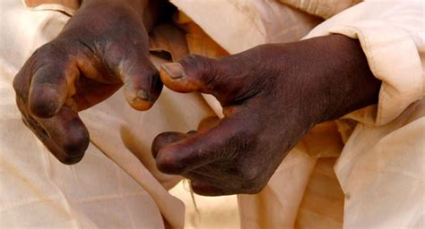 Leprosy Fact Sheet | Africa Health Organisation