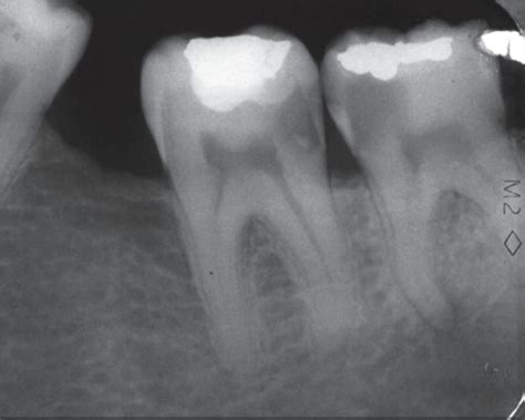 Preoperative radiograph of the second and third lower l | Open-i