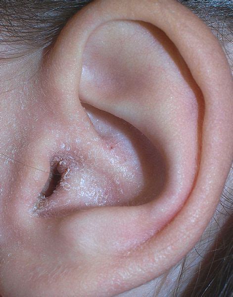 How to Treat Fungal Ear Infections | Swimmers ear remedy, Swimmers ear, Ear infection remedy