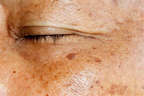 How To Remove Age Spots | tunersread.com