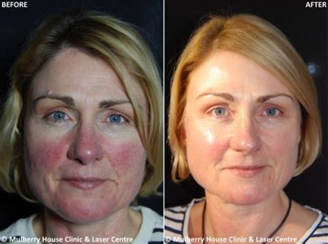 Case Study: Rosacea Treatment | Mulberry House Clinic