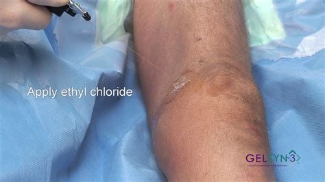 Superior Medial Extended Knee (GELSYN-3) - YouTube