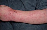 Allergy Notes: Defects of structural protein filaggrin as a risk factor for atopic dermatitis