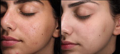 Clear Skin Laser Treatment | Sydney Cosmetic Laser | La Sante