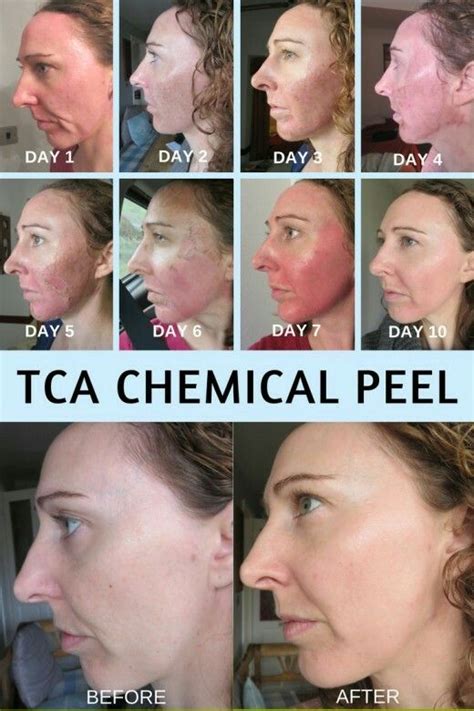 FAQ About TCA Chemical Peels – Cascades Med Spa