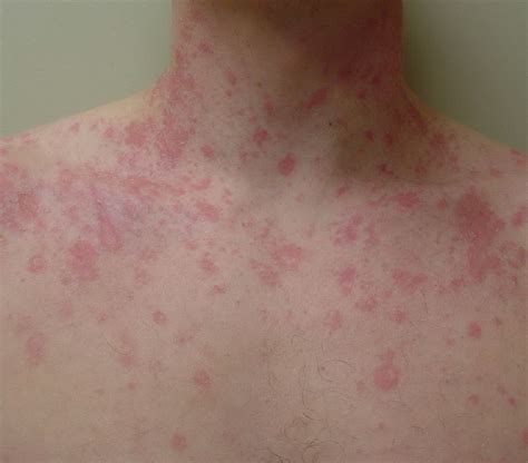 How To Describe Pityriasis Rosea Rash | Images and Photos finder