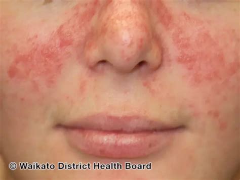 Psoriasis On The Face: Symptoms, Causes, Treatment, And, 56% OFF