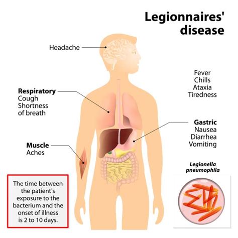 Legionnaires Disease Case Overview, Treament & Diagnosis