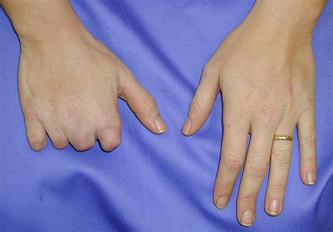 Finger Prosthesis - Hand Prosthesis | Milwaukee, WI — Life-like Prosthetics