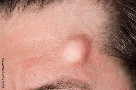 A large hematoma is seen up close on the forehead of a Caucasian man. Large raised lump symptom ...