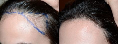 Hair Transplants for Women photos | Miami, FL | Patient71499