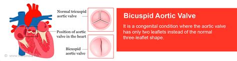 Bicuspid Aortic Valve - Causes, Symptoms, Complications, Diagnosis, Treatment, Prevention ...